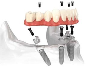 Типы зубных имплантатов